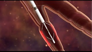 Bronchial Thermoplasty for Asthma [upl. by Ruyle]