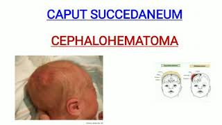 Caput succedaneum and cephalohematoma [upl. by Nolyad]