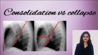 Chest X ray  How to differentiate consolidation from collapse [upl. by Av]