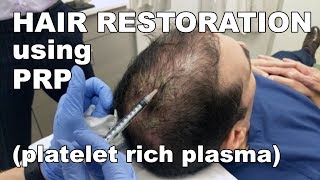 Scalp Hair Restoration using Platelet Rich Plasma  West End Plastic Surgery [upl. by Hazeefah614]