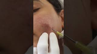 Subcision for Acne Scarring [upl. by Villada748]