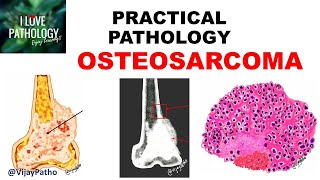 OSTEOSARCOMA Clinical  Radiological features amp Morphology [upl. by Latimore]