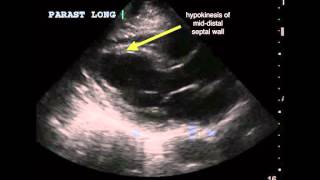 Apical ischemia [upl. by Earleen837]