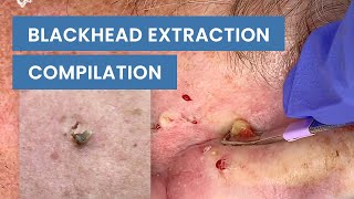 Extraction Satisfaction Blackhead Removal  CONTOUR DERMATOLOGY [upl. by Akcir199]