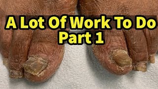 Severe Fungal Fungus Toenails A Lot Of Work To Do Part 1 [upl. by Mchale974]