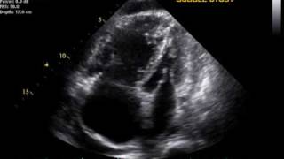 Pulmonary Hypertension echo [upl. by Graf50]