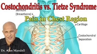 Costochondritis vs Tietzes Syndrome Pain in Chest Region  Dr Mandell [upl. by Attenaej]