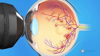 Combined Injection and Laser Treatment for Macular Edema [upl. by Debarath279]