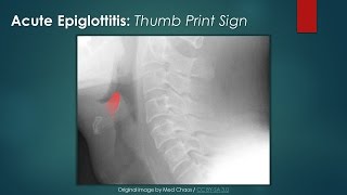 Acute Epiglottitis Thumb Sign [upl. by Bayly]