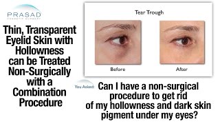 How Do I Get Rid of UnderEye Circles Without Surgery  Dr Anthony Youn [upl. by Daphne385]