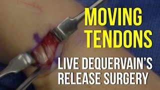 Moving Tendons In A Live Surgery  DeQuervain’s Release [upl. by Yatnoj]