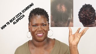 5 things that really work for CCCA or scarring alopecia [upl. by Onilecram]