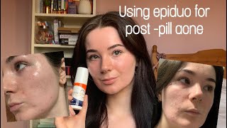 Starting Epiduo for acne 4 week update  tips 💖 [upl. by Cirtemed532]