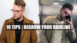 10 Quick Tips How To Stop A Receding Hairline amp Receding Hairline Regrowth [upl. by Norrej482]