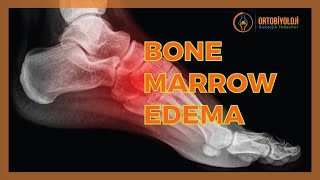 BONE MARROW EDEMA TREATMENTS [upl. by Joya9]