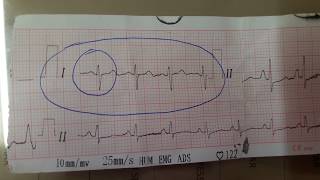 Cor Pulmonale ECG [upl. by Ardna]