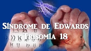 Síndrome de Edwards Trisomía 18 [upl. by Nosemyaj883]