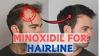 Minoxidil for Frontal Baldness  Restore Your Hairline [upl. by Eeleak983]