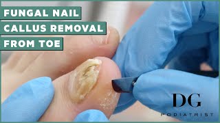 Fungal Nail Treatment And Callus Removal  The Foot Scraper DG Podiatrist [upl. by Noirret32]