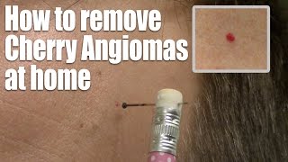 Two dermatology skin biopsies An angioma amp a cutaneous horn [upl. by Adnuahsor534]