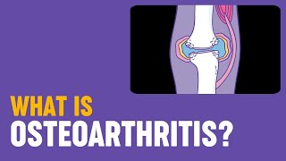 What is osteoarthritis [upl. by Oniliuqnart]