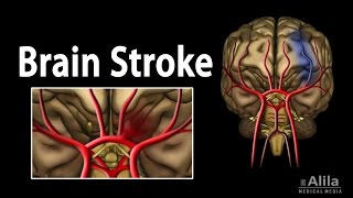 Stroke Causes and Risk Factors [upl. by Nuahsyd]