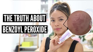 Clear Acne With Benzoyl Peroxide Pros and Cons [upl. by Jaqitsch]