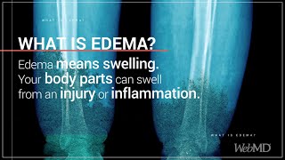 What is Edema  WebMD [upl. by Nylacaj]