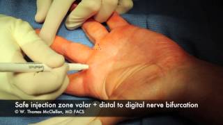 Live Surgery Digital Block Anesthesia of the Finger [upl. by Araz657]