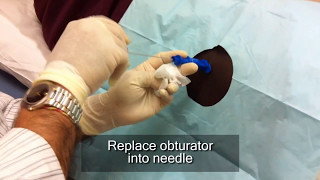 How To Do A Bone Marrow Aspiration amp Biopsy [upl. by Rednijar]