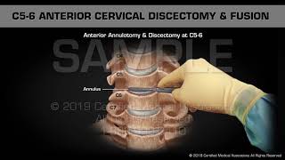 Anterior Cervical Discectomy amp Fusion at C56  Medical Animation [upl. by Gosser]