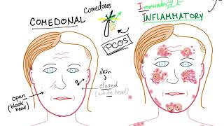 Acne Vulgaris causes subtypes and ttt [upl. by Vins401]