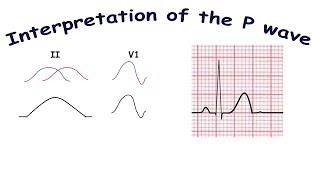 Interpretation of the P wave [upl. by Stanislas]