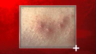 Signs of Bed Bug Bites  Health Checks [upl. by Aneet]