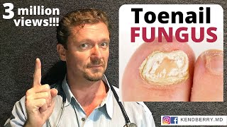 CURE Toenail Fungus And keep it Gone FOREVER [upl. by Jaella]