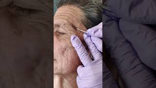 Acne extraction of blackheads and whiteheads popping pimples in Los Angeles [upl. by Ameline52]