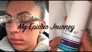 My Epiduo Journey Weeks 12 [upl. by Waki]