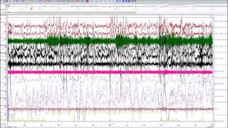 Scoring A Sleep Study Uncut Patient with RERAs UARS [upl. by Almira]