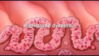 GENERAL PATHOLOGY 42 neoplasia part 1 DR SAMEH GHAZY [upl. by Aicre]