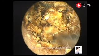 Left lateral auditory canal cholesteatoma clearance process clip 18 minutes [upl. by Guzel]