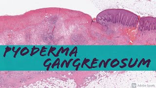 Pyoderma Gangrenosum vs NonSpecific Chronic Ulcer Changes [upl. by Latimore]