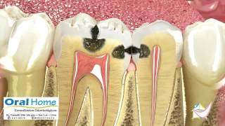 Icon Smooth Surface Caries Infiltrant Quick Guide [upl. by Verlie]