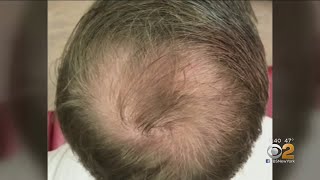 Can PRP Injections Spark Hair Growth [upl. by Grussing]