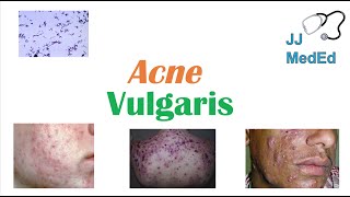 Acne Vulgaris  Causes Pathogenesis Influencing Factors Diagnosis Treatment and Complications [upl. by Cammy]