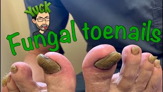 CUTTING LONG TOENAILS WITH FUNGUS [upl. by Atsugua]