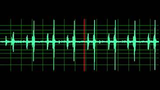 Pulmonary Associated Heart Sounds PAH Split S2 [upl. by Yerfoeg]