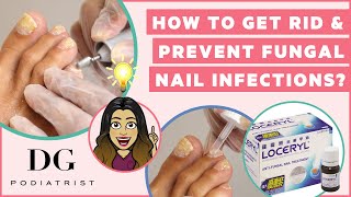 How to get rid and prevent toenail fungus [upl. by Nnylram]