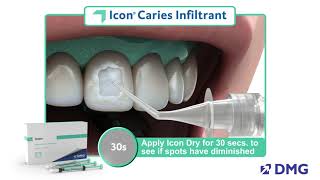 DENTAL CARIES Etiology Keyes Jordan diagram Stephans Curve SIMPLIFIED [upl. by Nalyac]