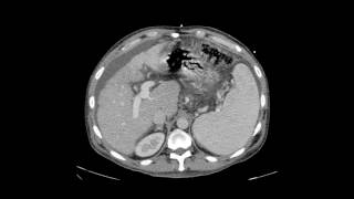 Transjugular Intrahepatic Portosystemic Shunt TIPS [upl. by Tsiuqram]