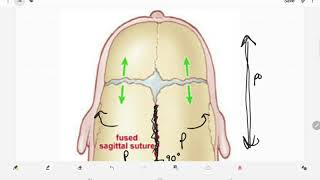 Craniosynostosis [upl. by Giliane]